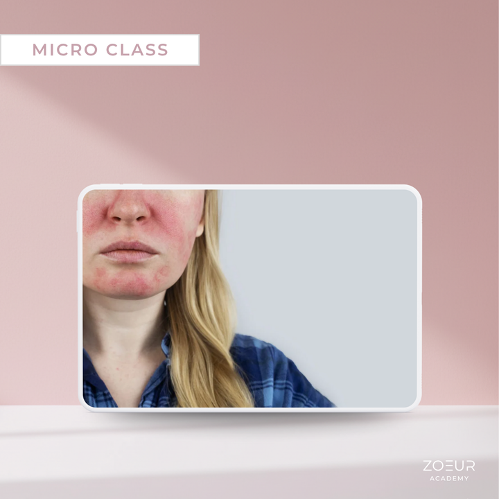Rosacea-Haut professionell behandeln: Micro Class